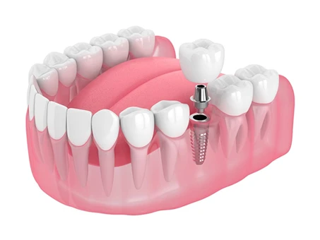 Implante de um dente em Santo André