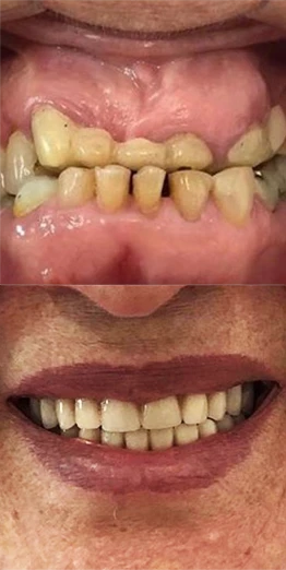Implantes Dentários