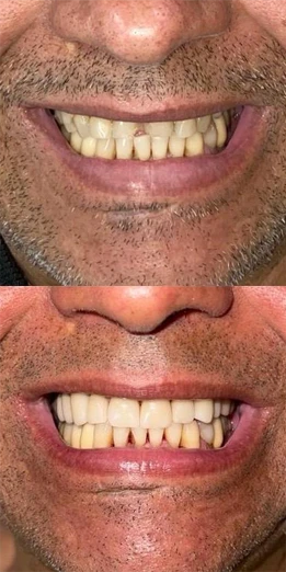 Implantes Dentários