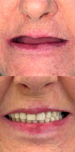 Implantes Dentários