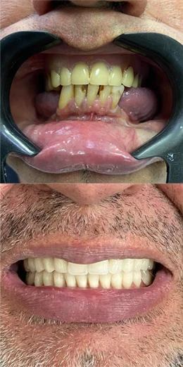 Implantes Dentários